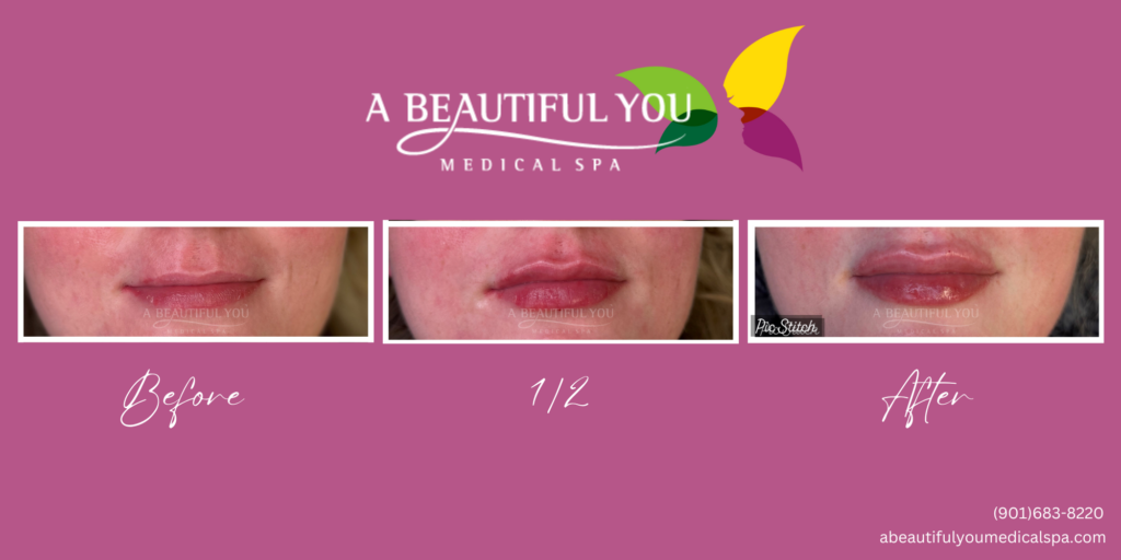 Lip Filler A Beautiful You Medical Spa