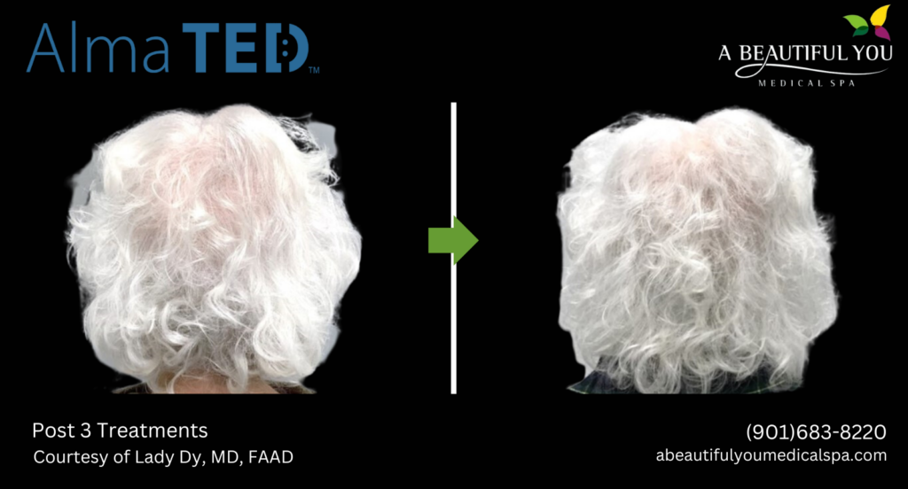 TED Hair Restoration