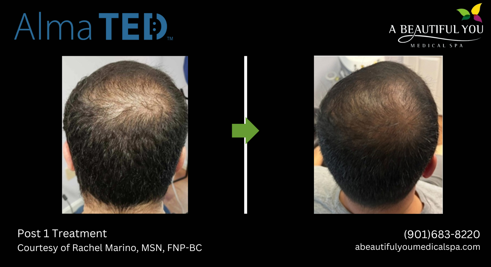 TED Hair Restoration