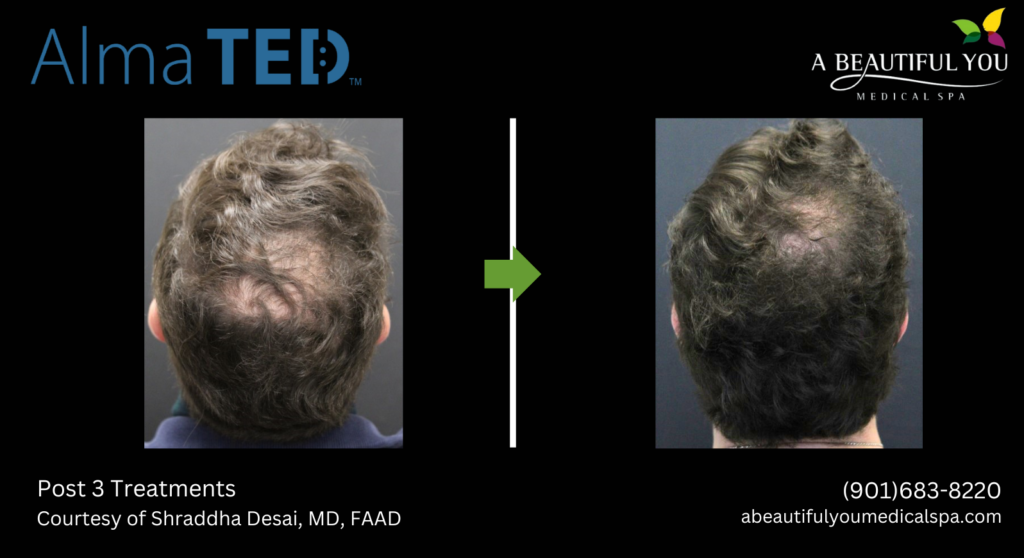 TED Hair Restoration