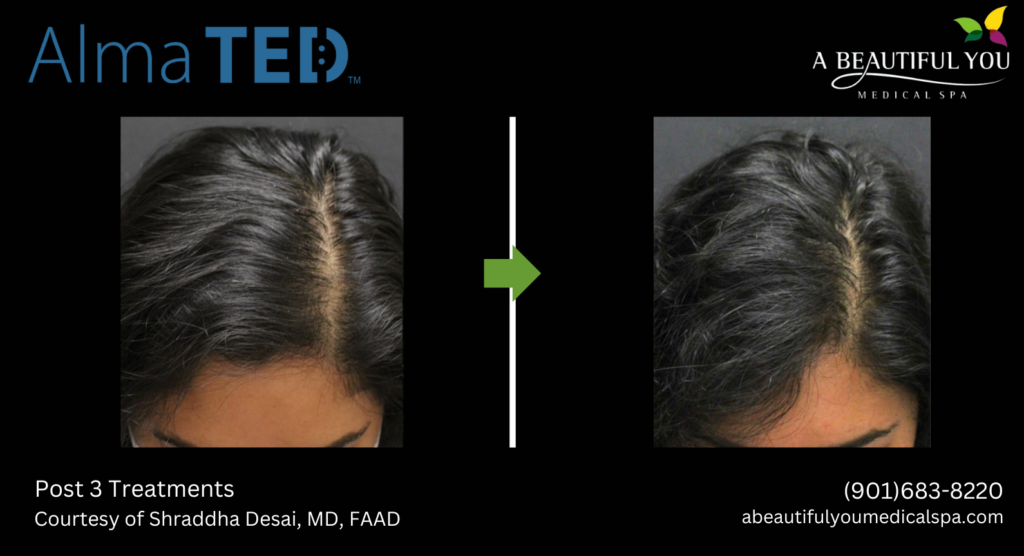 TED Hair Restoration