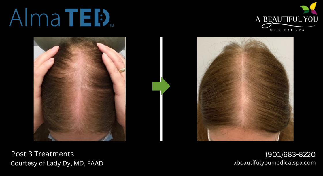 TED Hair Restoration