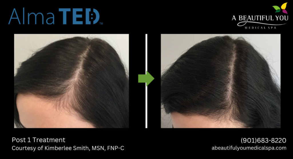 TED Hair Restoration