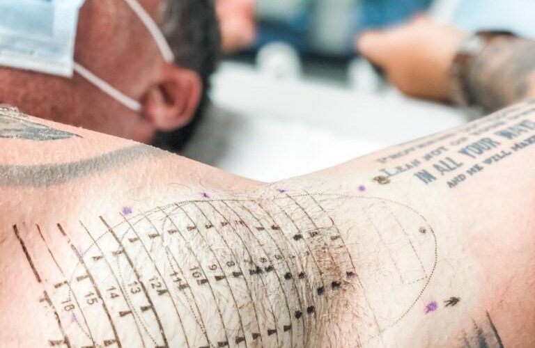 Close up of the miraDry temporary tattoo on a man's underarm for laser guidance