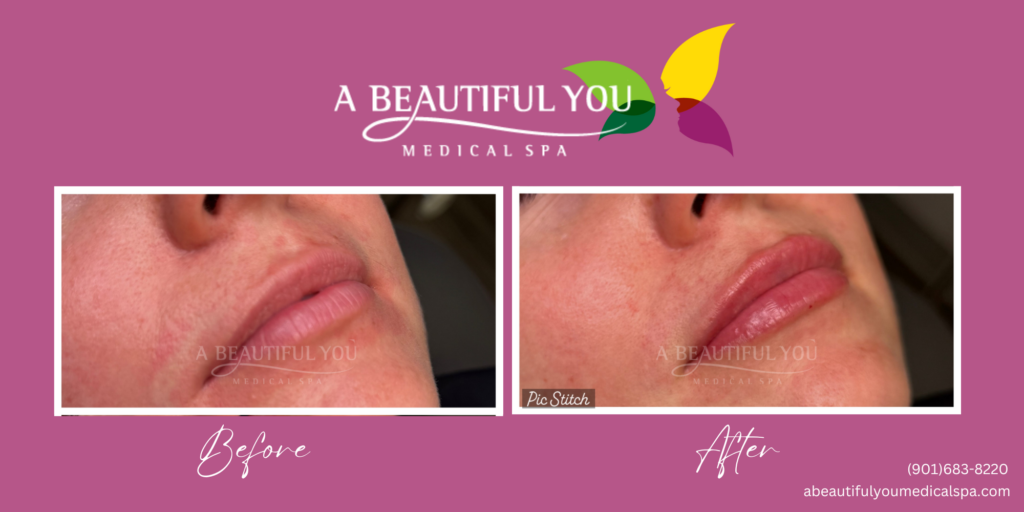 Dermal Filler Lips