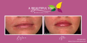 Dermal Filler Lips